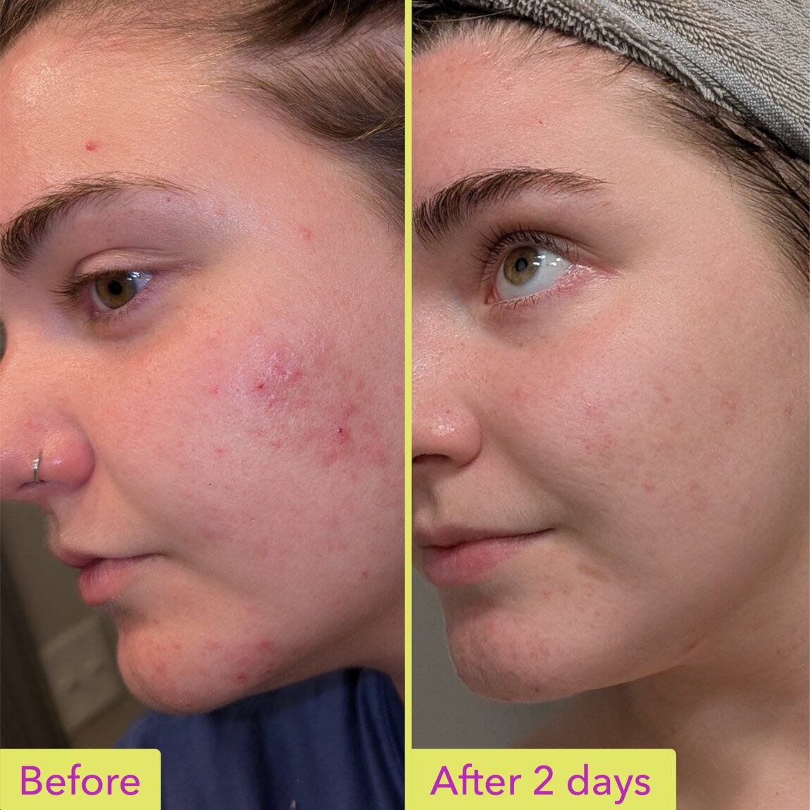 10-azelaic-acid-treatment-g7 zb_p.jpg