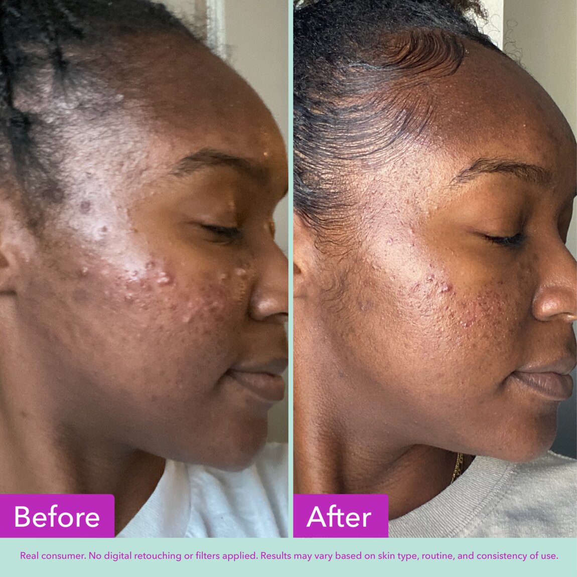 acne-foaming-cleanser-l5 zb_p.jpg