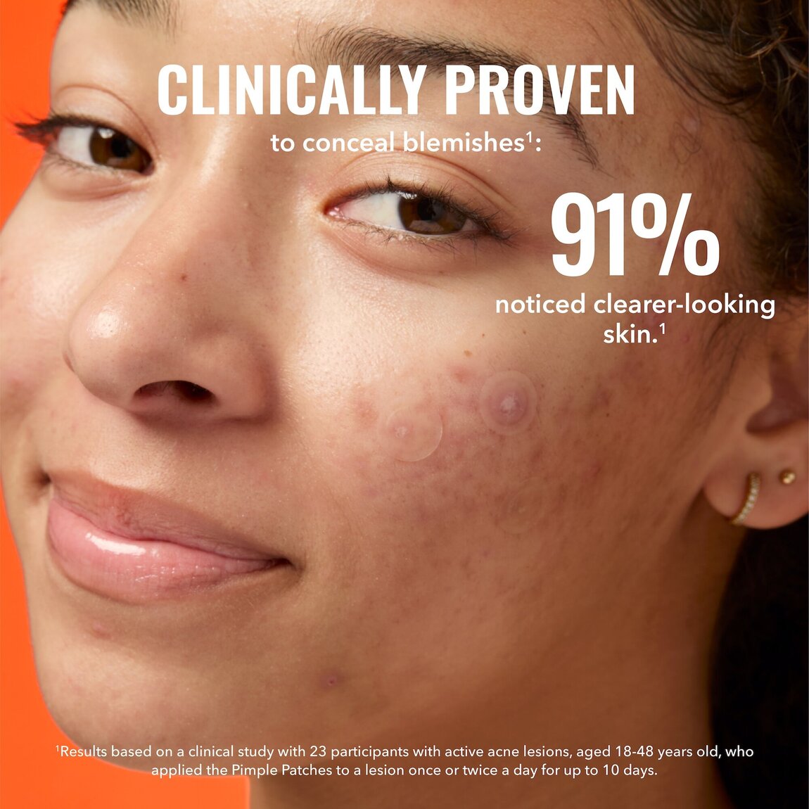pimple-patches-n9 zb_p.jpg